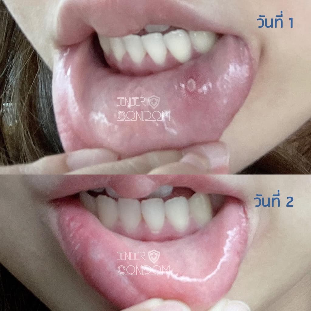 แผ่นแปะร้อนในแบบละลาย TIME ORAL ULCER PATCH ร้อนใน (แบบบรรจุ 4 ชิ้น และ รุ่นกล่อง บรรจุ 6 ชิ้น) รูปที่ 5