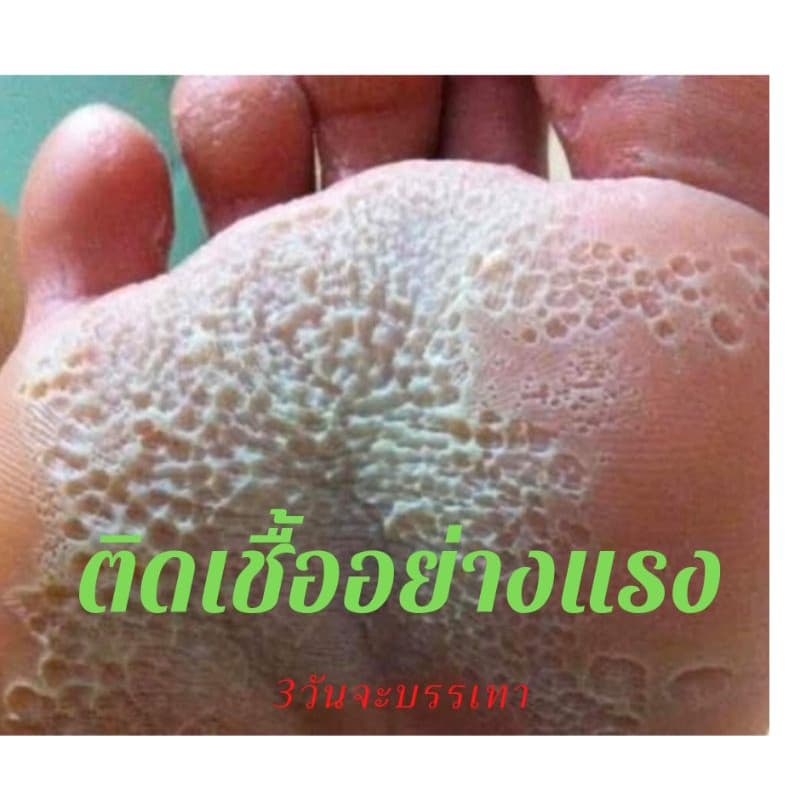 แป้งดับกลิ่นเท้า เท้าเหม็น เท้าเป็นรู รูปที่ 3