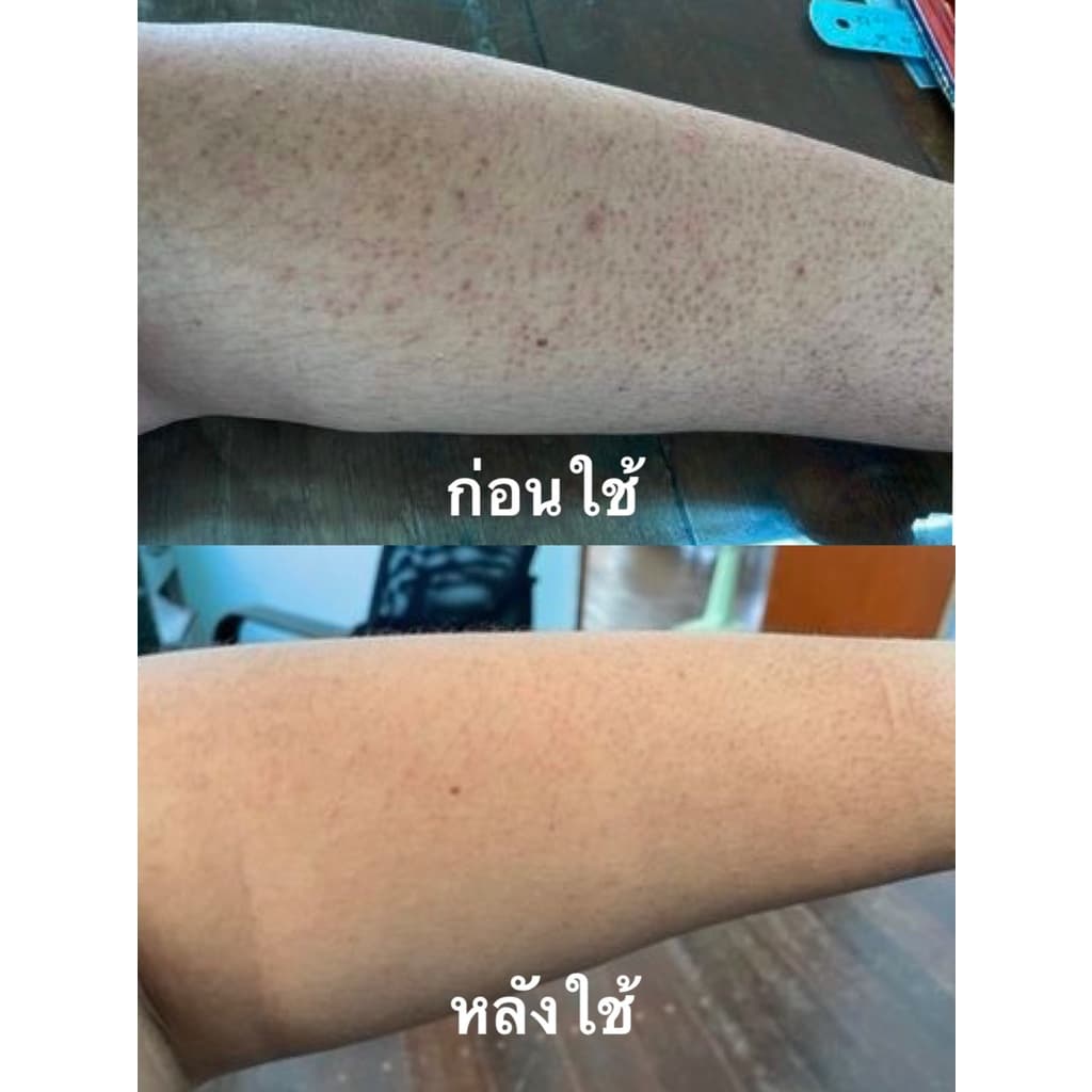 สเปรย์รักษาสิวที่หลัง สิวหน้าอก สิวใบหน้า สูตรแพทย์แผนไทย สเปรย์รักษารอยดำหลัง สเปรย์ใบชา รูปที่ 7