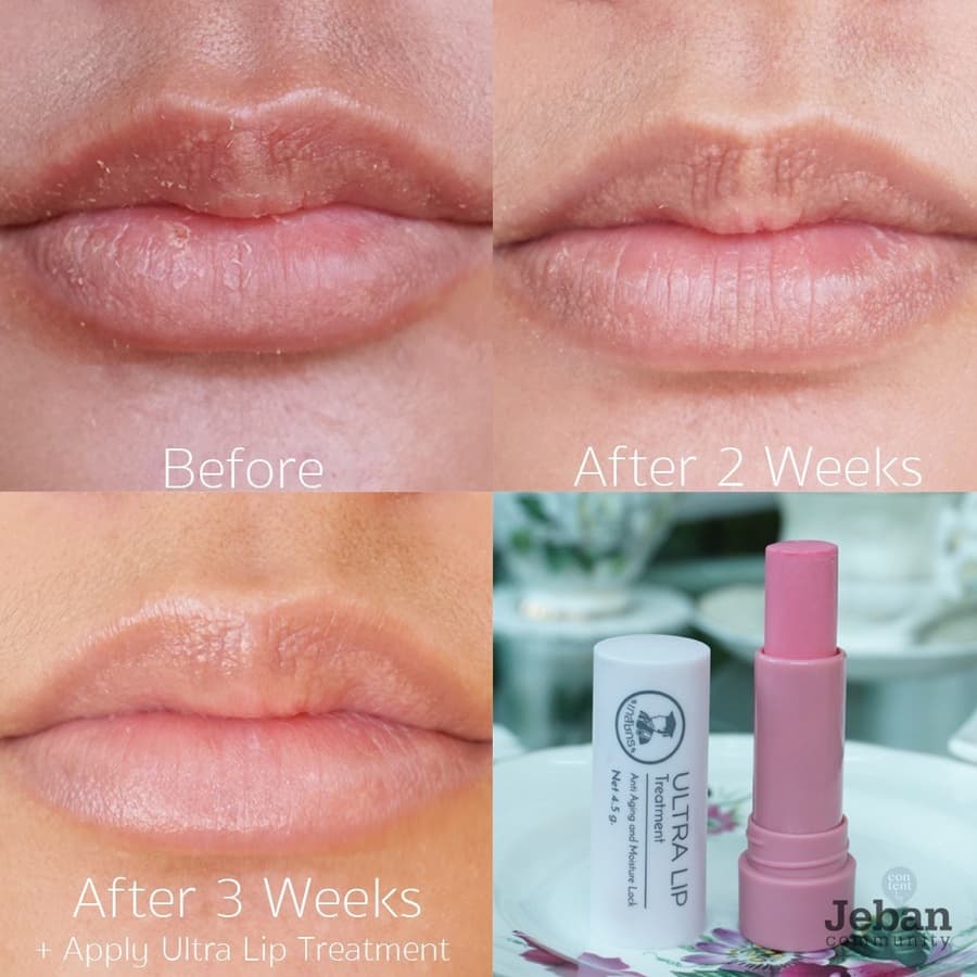 Ultra Lip Treatment 4.5 G. เภสัชกร แบบแท่ง อัลตราลิปทรีทเมนท์ ลิปมันเภสัช Ultralip รูปที่ 4