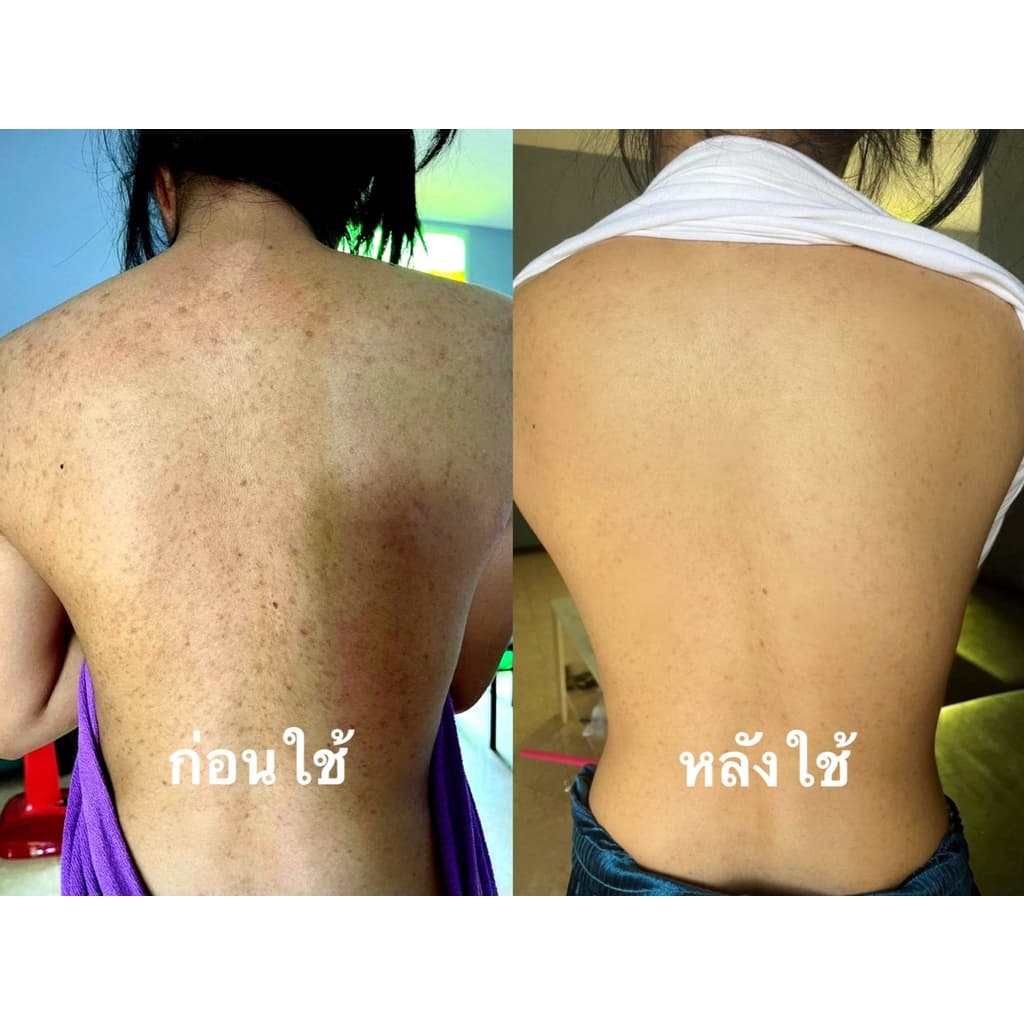 สเปรย์รักษาสิวที่หลัง สิวหน้าอก สิวใบหน้า สูตรแพทย์แผนไทย สเปรย์รักษารอยดำหลัง สเปรย์ใบชา รูปที่ 5