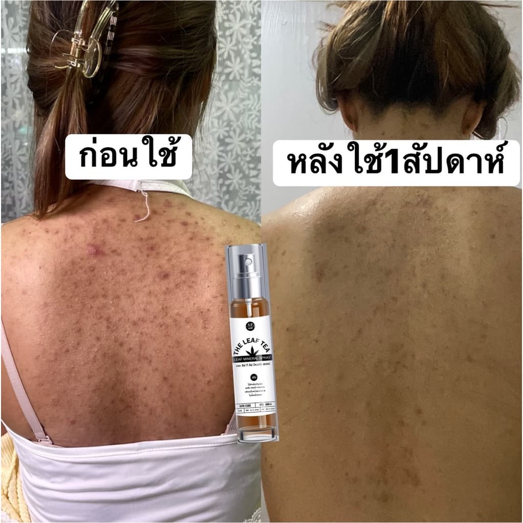 สเปรย์รักษาสิวที่หลัง สิวหน้าอก สิวใบหน้า สูตรแพทย์แผนไทย สเปรย์รักษารอยดำหลัง สเปรย์ใบชา รูปที่ 9