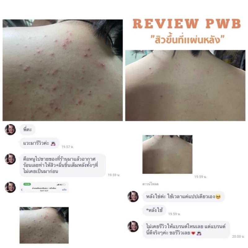 ของแท้ มีบัตรตท. ครีมทาก้น PWB แพ็คเกจใหม่ New ไม่ระบุชื่อสินค้า กุ้นลาย ผดสิ้วว รอยแตกลาย ดำด้าน รูปที่ 7