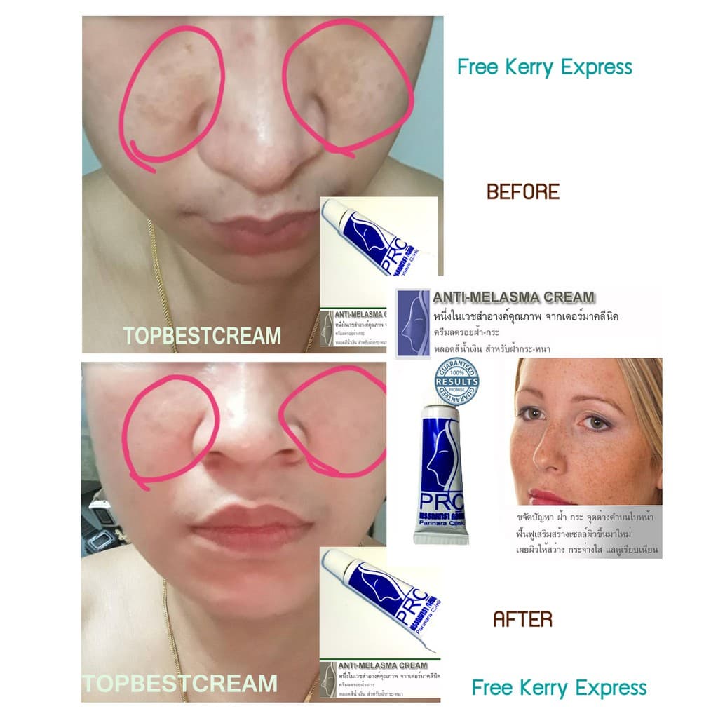 ครีมทาฝ้า กระ ชนิดหนา เดอร์มา ลึก รอย จุดด่างดำ คล้ำ บนใบหน้า ขนาด 3 กรัม Anti-Melasma Cream 3 g. รูปที่ 3