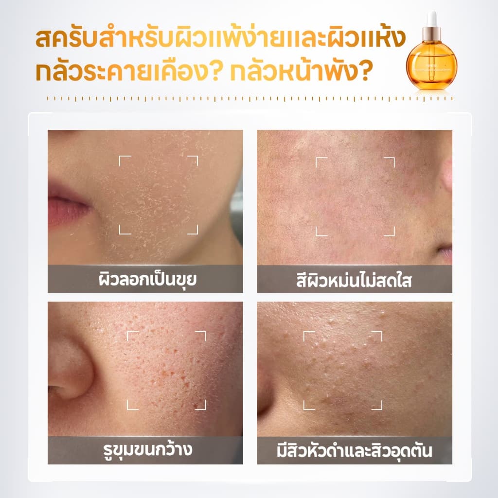 PAPA FEEL 0 Acid Peeling Serum เซรั่มเพื่อการ ผิวกระจ่างใส กระชับรูขุมขน ลดสิว PAPAIN BROMELAIN 8D Hyaluronic Acid essence 30ml รูปที่ 3