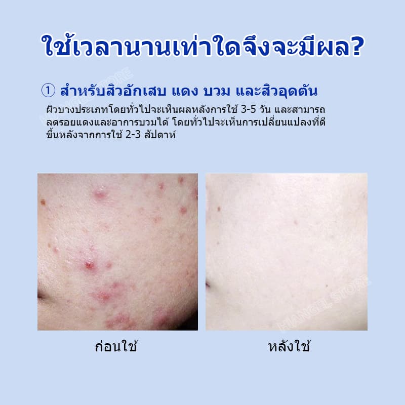 เอสเซนส์รักษาสิวไนอะซินาไมด์ กำจัดสิวได้อย่างมีประสิทธิภาพและรวดเร็ว บรรเทาอาการอักเสบ ลดรอยแผลเป็นจากสิว การควบคุมน้ำมัน การป้องกันการเกิดสิวซ้ำ Niacinamide Acne Treatment Serum Hiangel รูปที่ 8