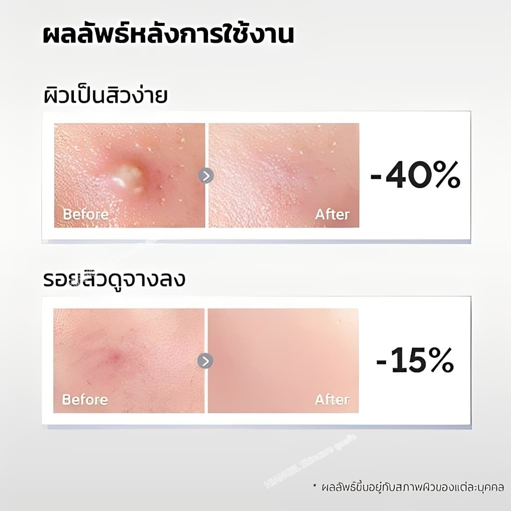 เอสเซนส์รักษาสิวไนอะซินาไมด์ กำจัดสิวได้อย่างมีประสิทธิภาพและรวดเร็ว บรรเทาอาการอักเสบ ลดรอยแผลเป็นจากสิว การควบคุมน้ำมัน การป้องกันการเกิดสิวซ้ำ Niacinamide Acne Treatment Serum Hiangel รูปที่ 3