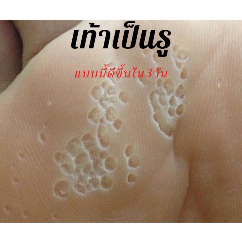 แป้งดับกลิ่นเท้า เท้าเหม็น เท้าเป็นรู รูปที่ 2