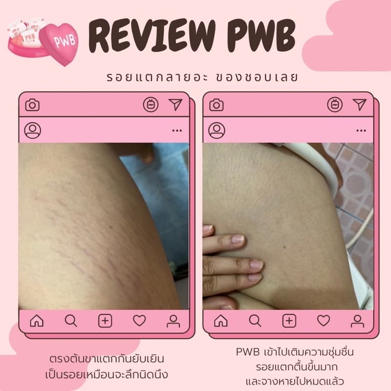 ของแท้ มีบัตรตท. ครีมทาก้น PWB แพ็คเกจใหม่ New ไม่ระบุชื่อสินค้า กุ้นลาย ผดสิ้วว รอยแตกลาย ดำด้าน รูปที่ 8