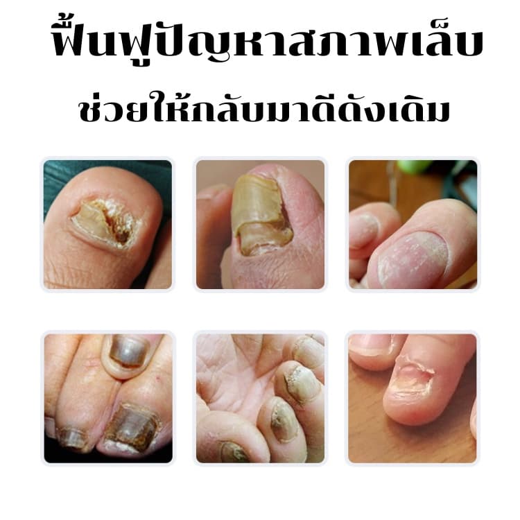 ฆ่าเชื้อราที่เล็บ เซรั่ม รักษาเล็บ ซ่อมเล็บที่ชำรุด เชื้อราในเล็บ บำรุงเล็บ ที่เสีย รูปที่ 5