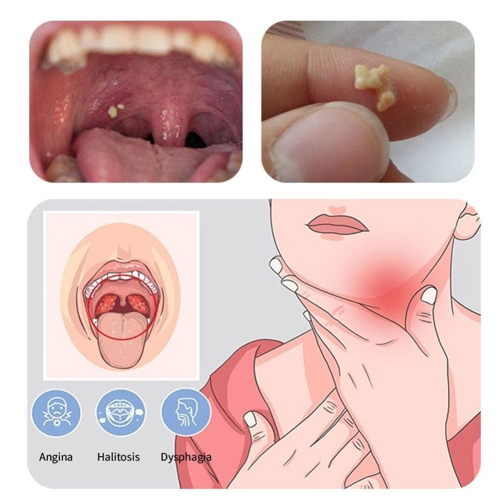 Timekey Tonsil หินเครื่องมือกําจัดไฟ LED สแตนเลส Remover ปากทําความสะอาด Care เครื่องมือ Tonsil Stone Remover เครื่องมือทําความสะอาด D3S4 รูปที่ 6