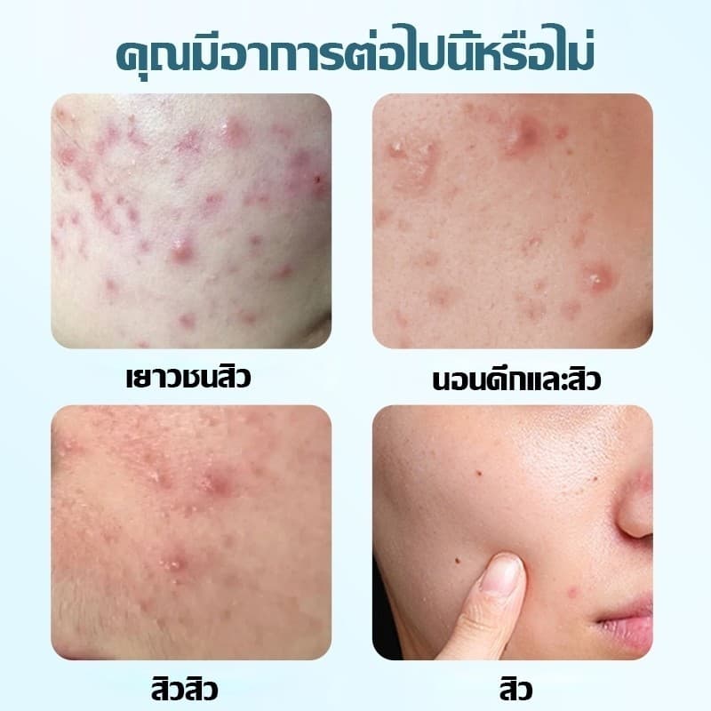 แผ่นแปะสิว แผ่นแปะรักษาสิว แผ่นสิว แผ่นแปะดูดสิว แผ่นดูดสิว แผ่นสติกเกอร์แปะสิว Acne Patches รูปดาวน่ารัก หลากสีสัน 7 สี รูปที่ 6
