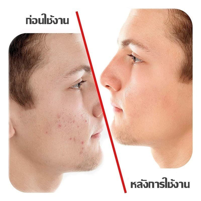 แผ่นแปะสิว แผ่นแปะรักษาสิว แผ่นสิว แผ่นแปะดูดสิว แผ่นดูดสิว แผ่นสติกเกอร์แปะสิว Acne Patches รูปดาวน่ารัก หลากสีสัน 7 สี รูปที่ 4