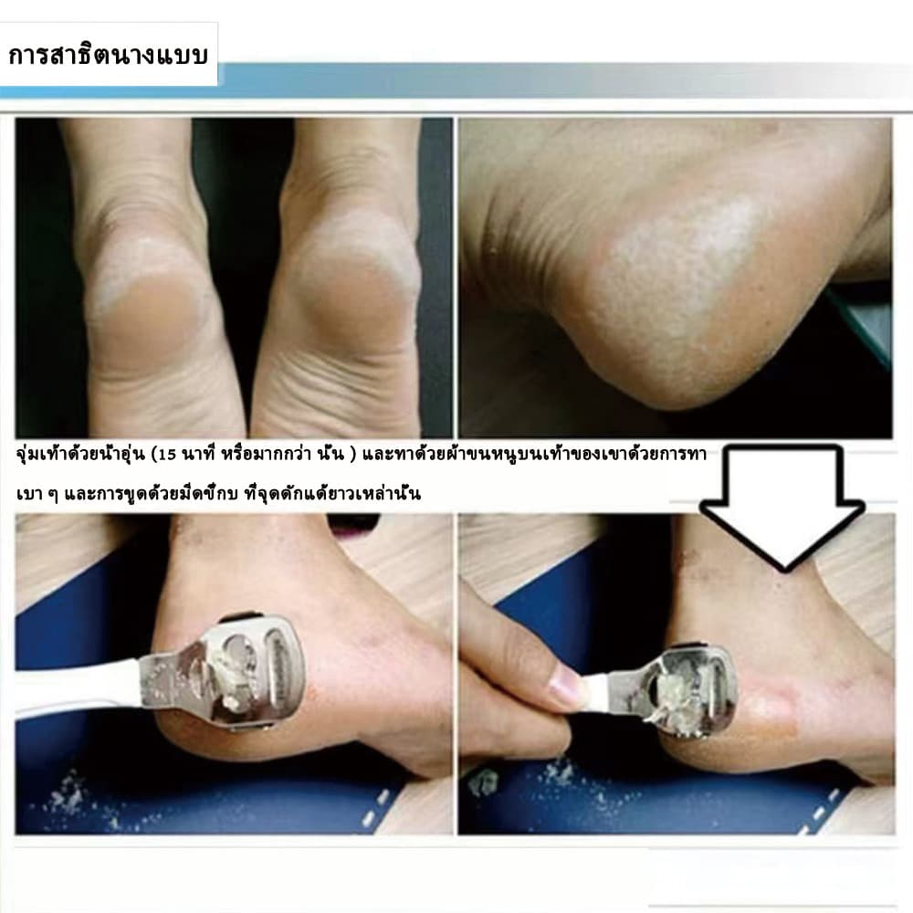 Tia la homeที่ขูดส้นเท้า มีดโกนส้นเท้า พร้อมใบมีด 10 ชิ้น Heel scraper ใบมีดขูดส้นเท้า ส้นเท้าแตก รูปที่ 7
