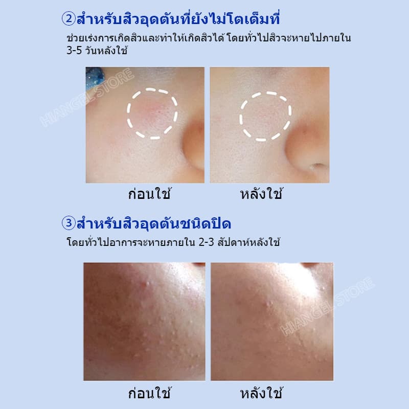 เอสเซนส์รักษาสิวไนอะซินาไมด์ กำจัดสิวได้อย่างมีประสิทธิภาพและรวดเร็ว บรรเทาอาการอักเสบ ลดรอยแผลเป็นจากสิว การควบคุมน้ำมัน การป้องกันการเกิดสิวซ้ำ Niacinamide Acne Treatment Serum Hiangel รูปที่ 9