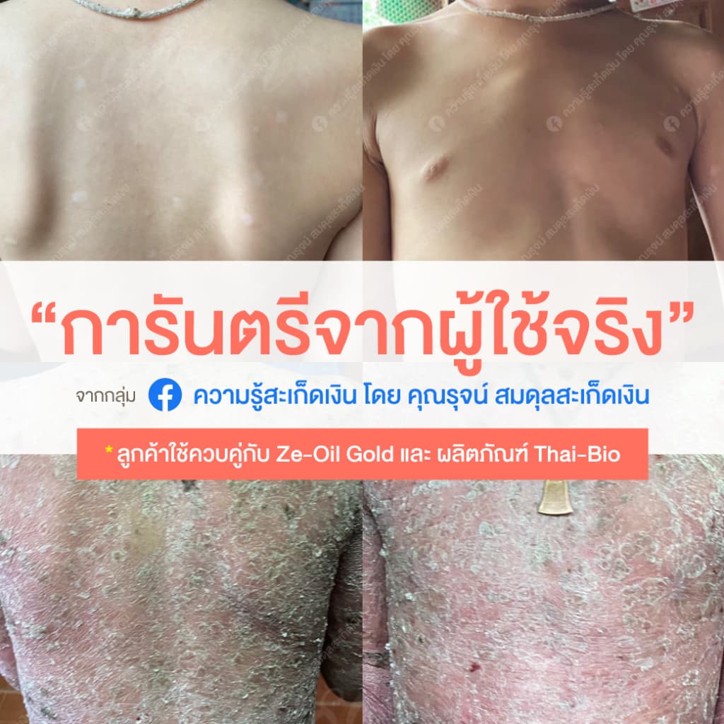 ครีมโอโซน สำหรับคนที่เป็นสะเก็ดเงิน และ คนที่มีปัญหาผิวหนังทุกชนิด ฟื้นฟูผิวและรอยแผล รูปที่ 4
