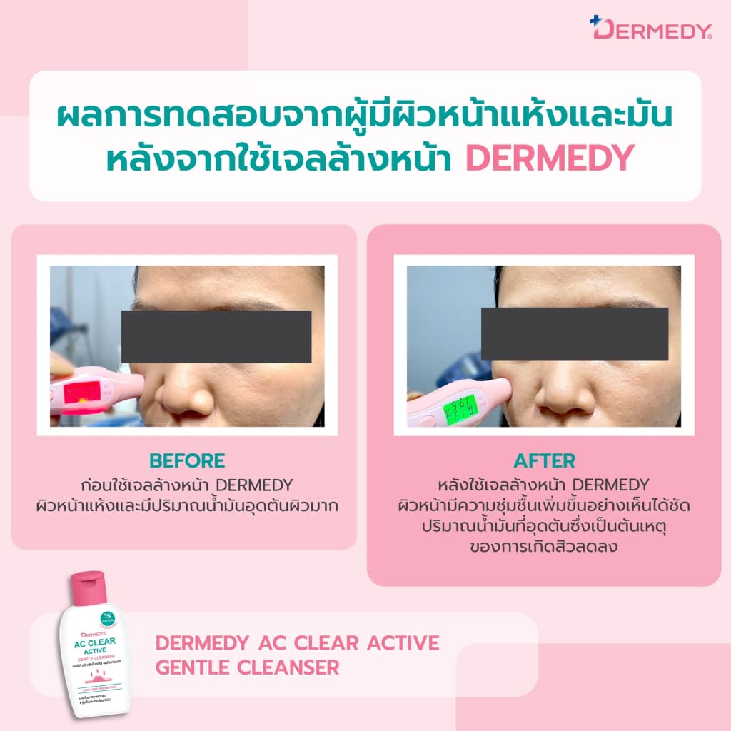 DERMEDY AC CLEAR ACTIVE GENTLE CLEANSER เดอร์มีดี เอซี เคลียร์ แอคทีฟ เจนเทิล คลีนเซอร์ รูปที่ 5
