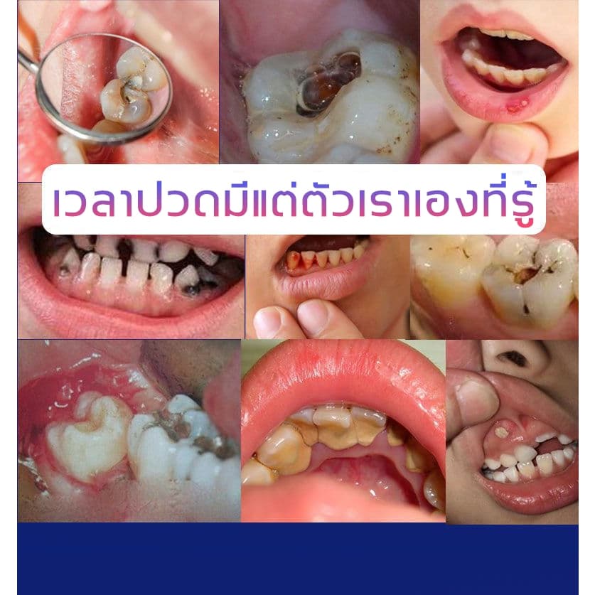YIMIWEILAI แก้ปวดฟัน เหงือกอักเสบ ใช้หมดก็เห็นผล ช่วยลดอาการเจ็บฟันได้เป็นอย่างดี สเปรย์พ่นคอ ปวดฟัน สเปรย์แก้ปวดฟัน รูปที่ 2