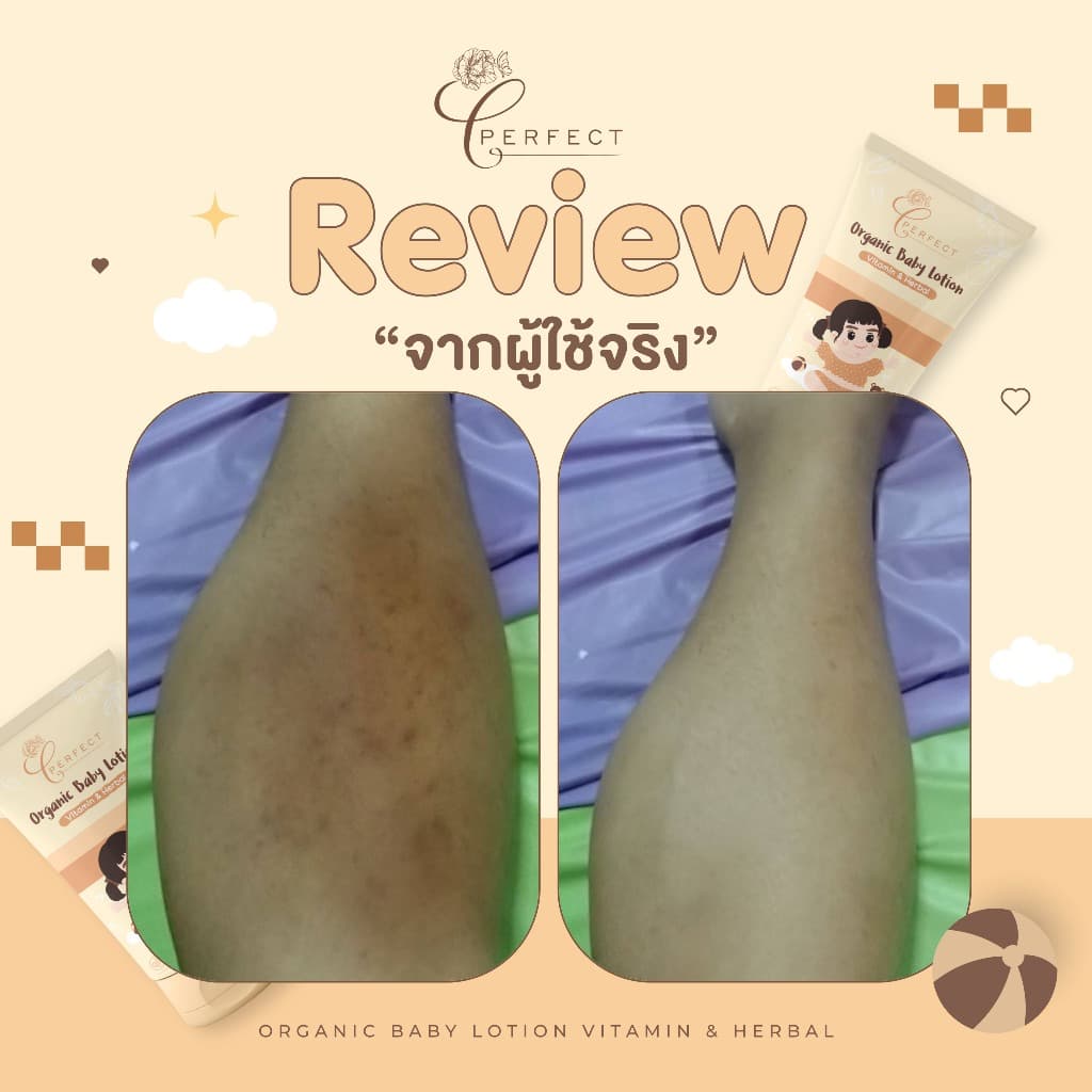 PERFECT โลชั่นเด็กออร์แกนิค บำรุงผิวขาวกระจ่างใส แก้ขาลาย ลดรอยยุงกัด กู้ผิวคล้ำเสีย รูปที่ 9
