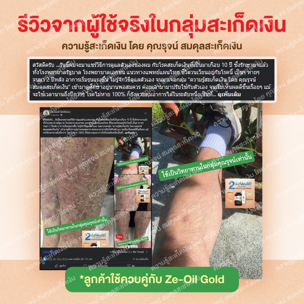 ครีมโอโซน สำหรับคนที่เป็นสะเก็ดเงิน และ คนที่มีปัญหาผิวหนังทุกชนิด ฟื้นฟูผิวและรอยแผล รูปที่ 3