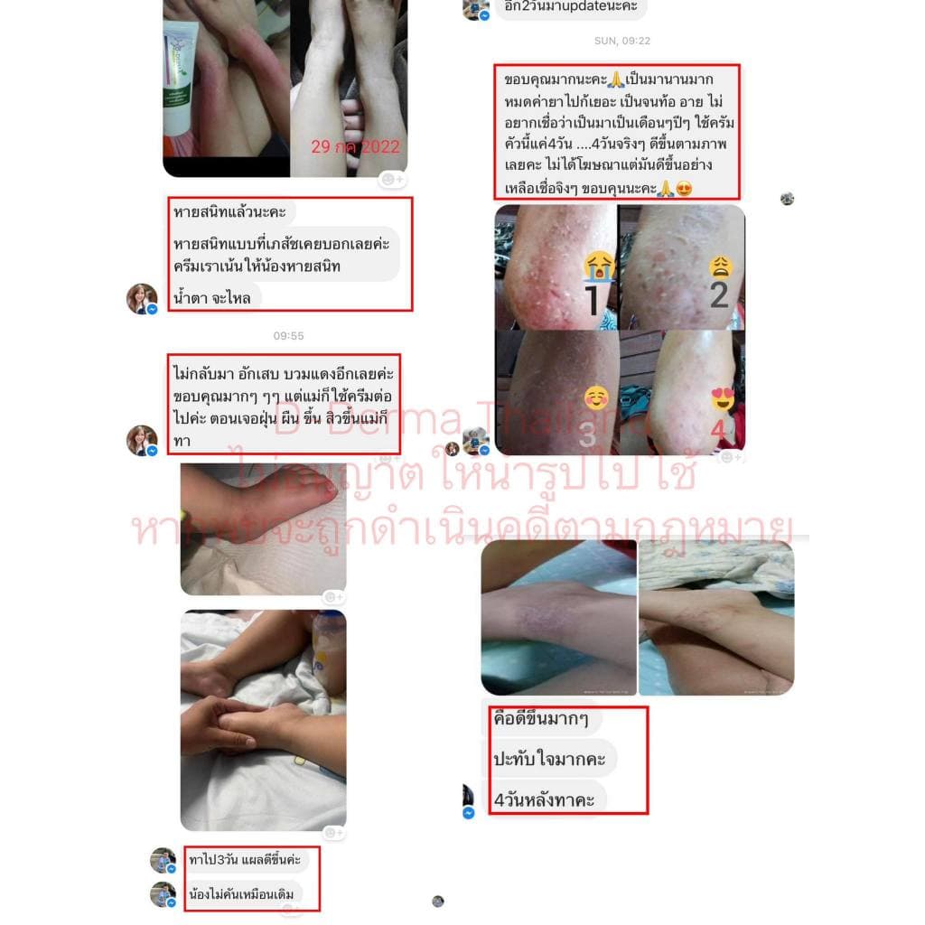 D-Derma สบู่ว่าน1 และครีมว่าน 1 การคัน ผดผื่น อาการแพ้ ผิวหนังอักเสบ กลากเกลื้อน เชื้อรา เซ็บเดิร์ม รูปที่ 5