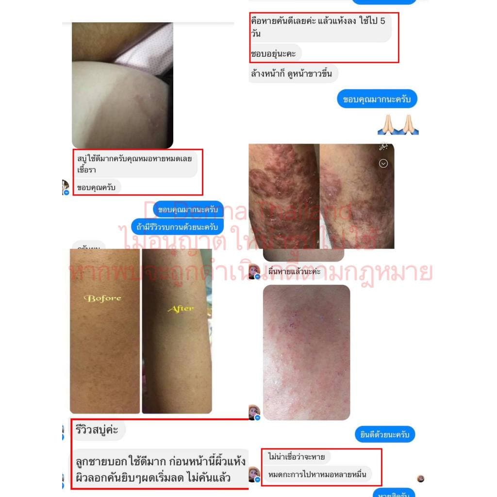 D-Derma สบู่ว่าน1 และครีมว่าน 1 การคัน ผดผื่น อาการแพ้ ผิวหนังอักเสบ กลากเกลื้อน เชื้อรา เซ็บเดิร์ม รูปที่ 3
