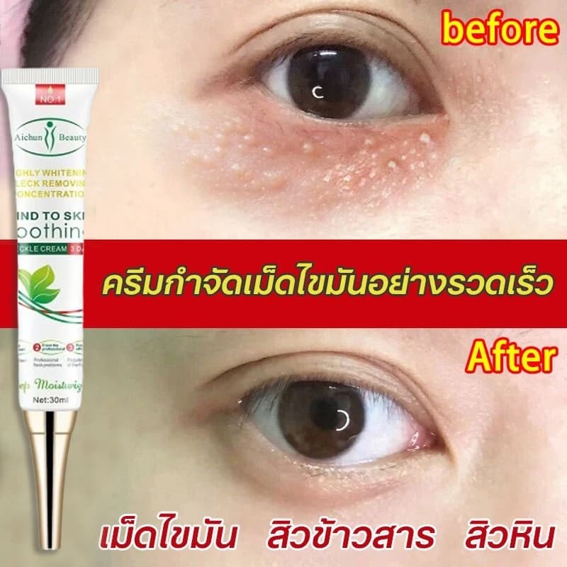 ครีมบำรุงรอบตา ครีมทาตาเม็ดไขมัน ขจัดเม็ดไขมัน 30ml ครีมกำจัดสิวข้าวสาร สิวเม็ดข้าวสาร สิวหิน ขจัดเม็ดไขม ซ่อมแซมผิว รูปที่ 1