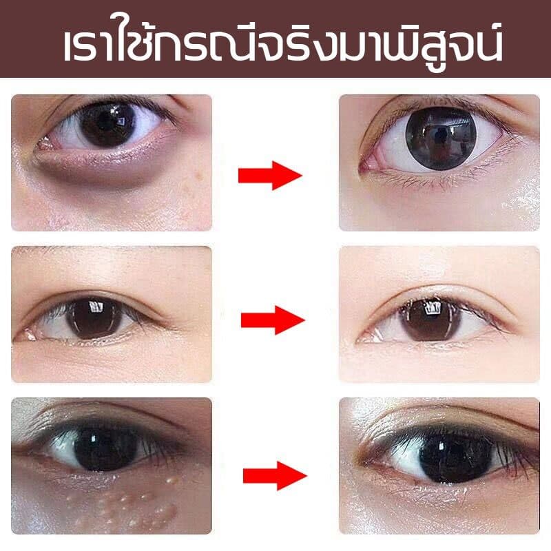 ครีมบำรุงรอบตา ครีมทาตาเม็ดไขมัน ขจัดเม็ดไขมัน 30ml ครีมกำจัดสิวข้าวสาร สิวเม็ดข้าวสาร สิวหิน ขจัดเม็ดไขม ซ่อมแซมผิว รูปที่ 2