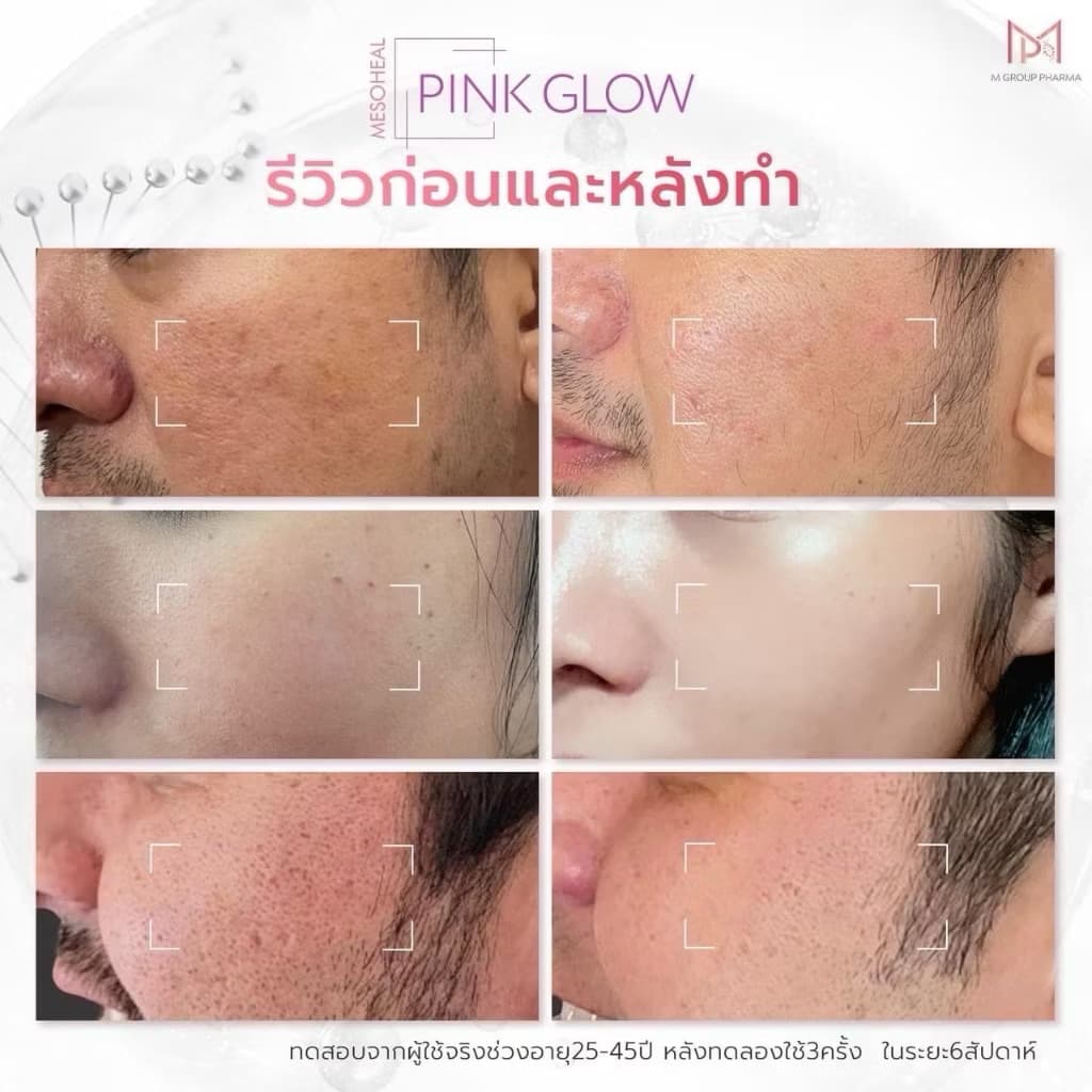 PINK GLOW Mesoheal อย.ไทย เช็คแท้ถูกชัวร์ รูปที่ 5