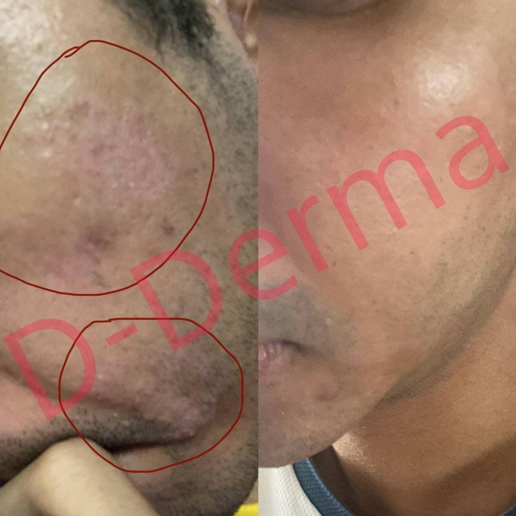 เซรั่ม Anti-sebderm D-Derma เซ็บเดิร์ม ผิวแห้ง ลอก คัน ผิวหนังอักเสบ แพ้ง่าย ผดผื่น sebderm รูปที่ 9