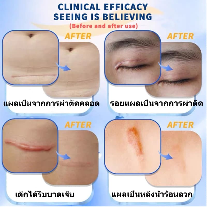 DERMATIX ULTRA GEL 15G. เจลป้องกันรอยแผลเป็น รูปที่ 4