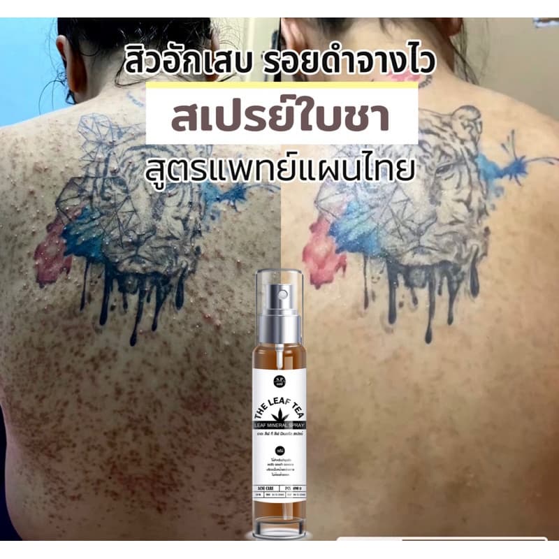 สเปรย์รักษาสิวที่หลัง สิวหน้าอก สิวใบหน้า สูตรแพทย์แผนไทย สเปรย์รักษารอยดำหลัง สเปรย์ใบชา รูปที่ 2
