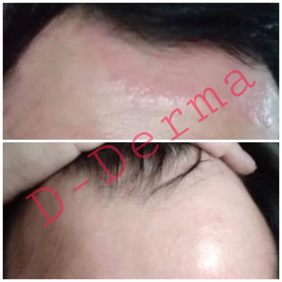 เซรั่ม D-Derma เซ็บเดิร์ม ผิวแห้ง ลอก คัน แดง ผิวแข็งแรง แพ้ ผิวหนังอักเสบ ผดผื่น ชุ่มชื่น รูปที่ 4
