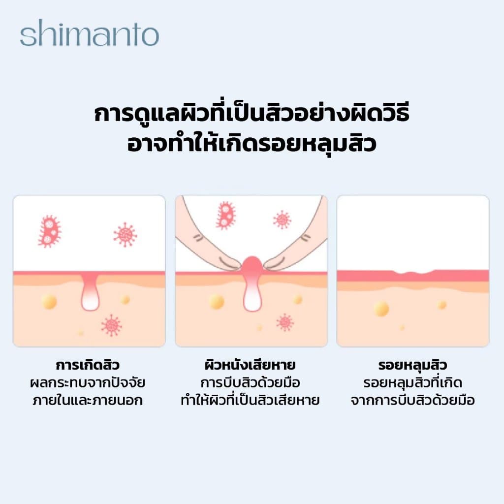 Shimanto แท้ แผ่นแปะสิว กันน้ำกันเหงื่อ ไม่มันเงา ผิวแพ้ง่ายใช้ได้ รักษาและปกปิดสิวอักเสบ รูปที่ 6