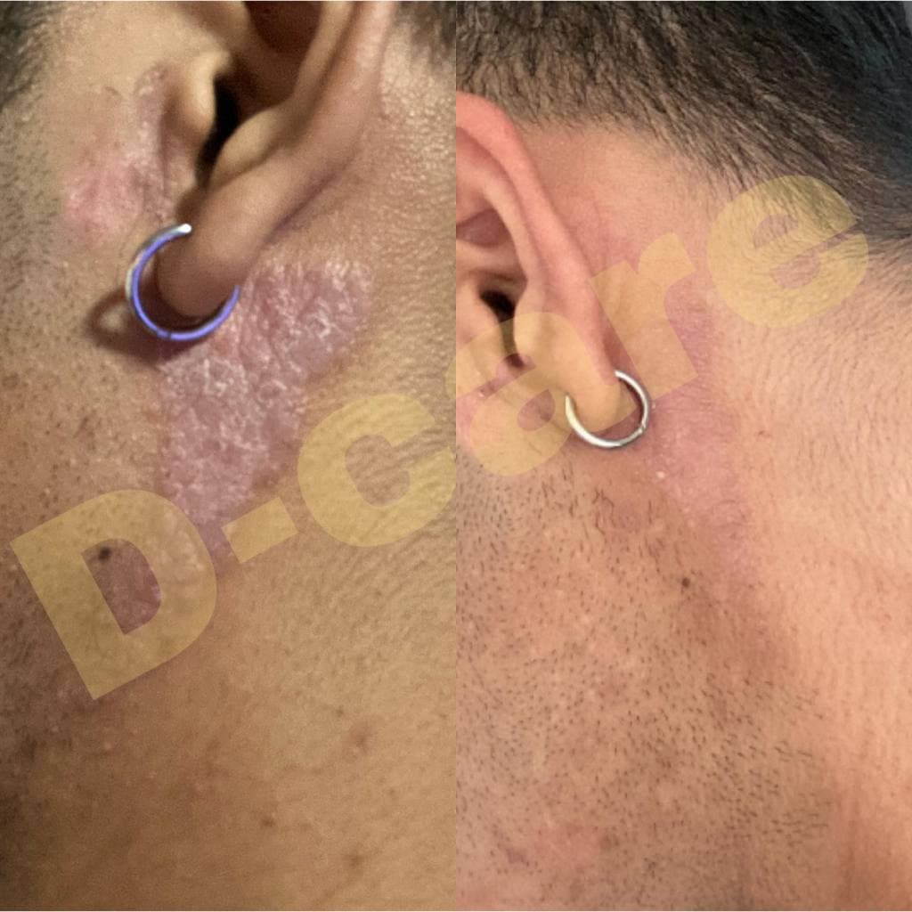 เซรั่ม D-Derma เซ็บเดิร์ม ผิวแห้ง ลอก คัน แดง ผิวแข็งแรง แพ้ ผิวหนังอักเสบ ผดผื่น ชุ่มชื่น รูปที่ 3