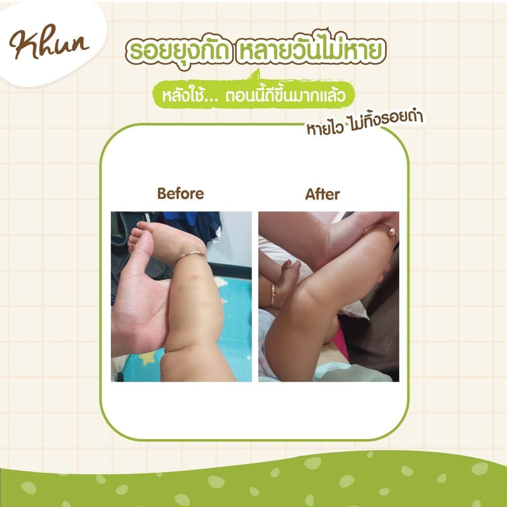 KHUN เจลทากันยุงกัด ลดบวม ไม่ทิ้งรอยดำ สูตรออร์แกนิค อ่อนโยน สำหรับเด็ก รูปที่ 9
