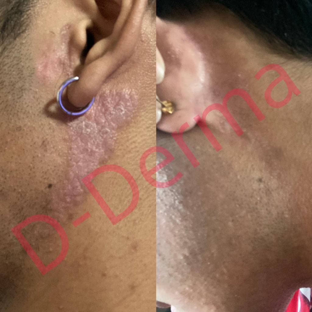 เซรั่ม D-Derma เซ็บเดิร์ม ผิวแห้ง ลอก คัน แดง ผิวแข็งแรง แพ้ ผิวหนังอักเสบ ผดผื่น ชุ่มชื่น รูปที่ 7