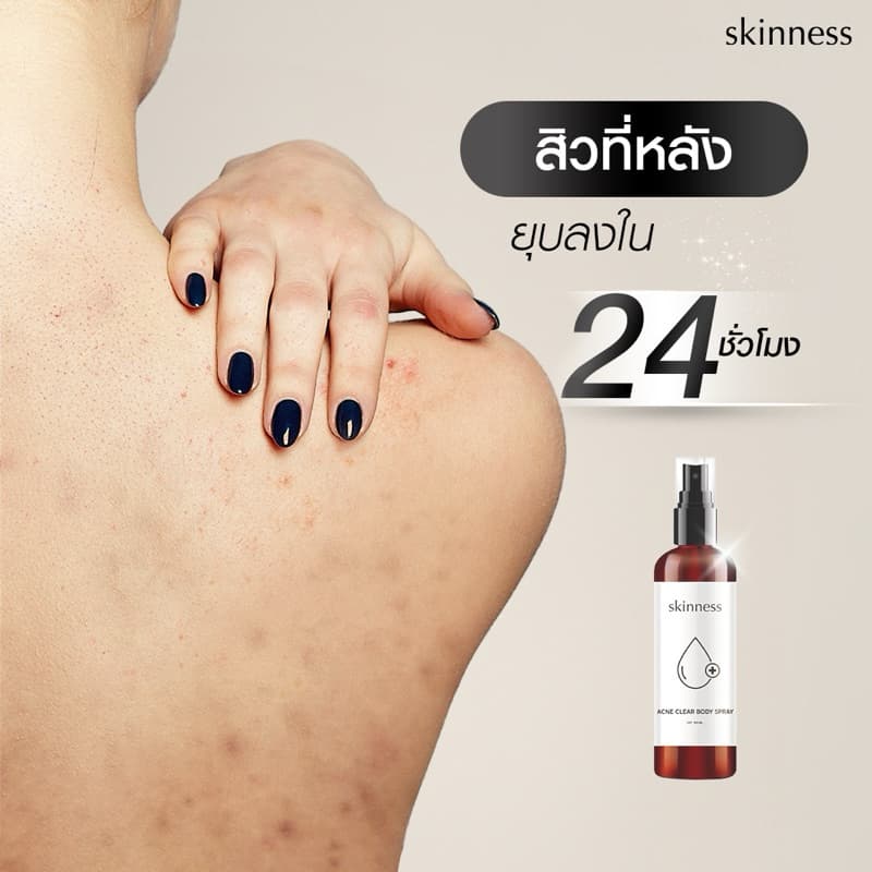 skinness acne clear body spray | สเปรย์ฉีดลดสิวบริเวณผิวกาย รูปที่ 4