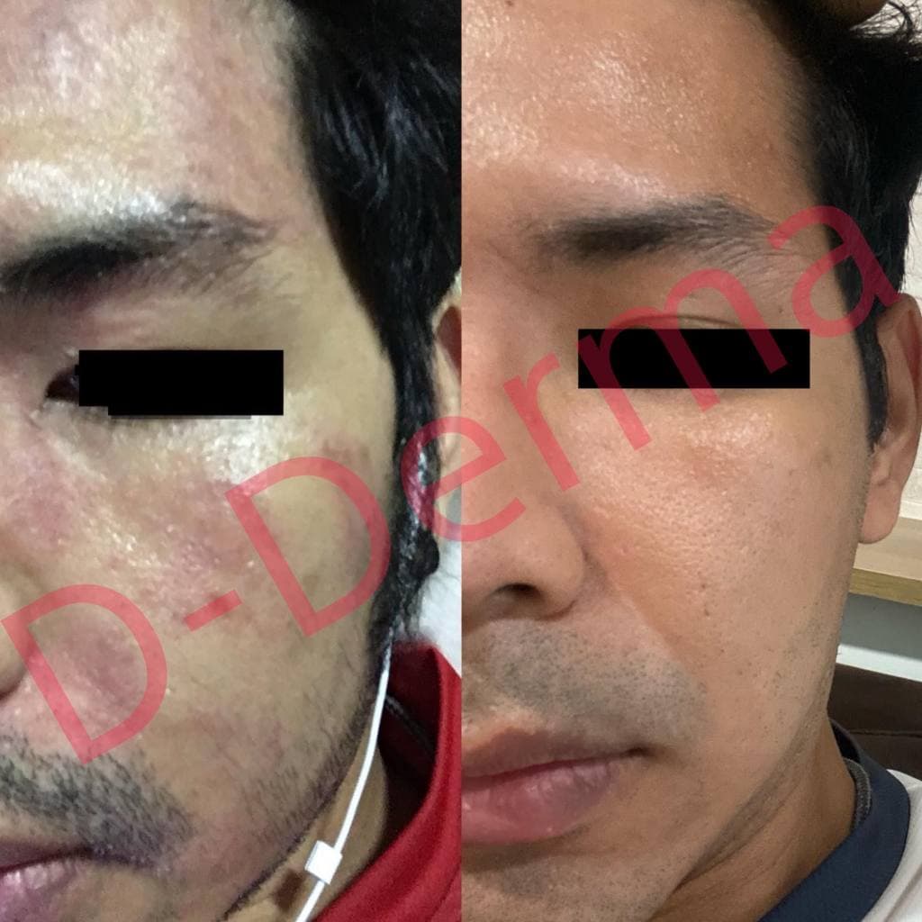 เซรั่ม D-Derma เซ็บเดิร์ม ผิวแห้ง ลอก คัน แดง ผิวแข็งแรง แพ้ ผิวหนังอักเสบ ผดผื่น ชุ่มชื่น รูปที่ 2