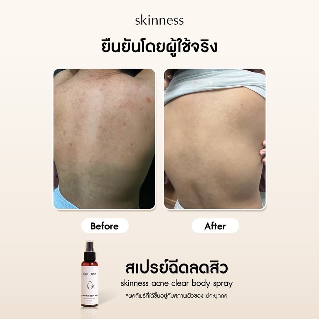 skinness acne clear body spray | สเปรย์ฉีดลดสิวบริเวณผิวกาย รูปที่ 5