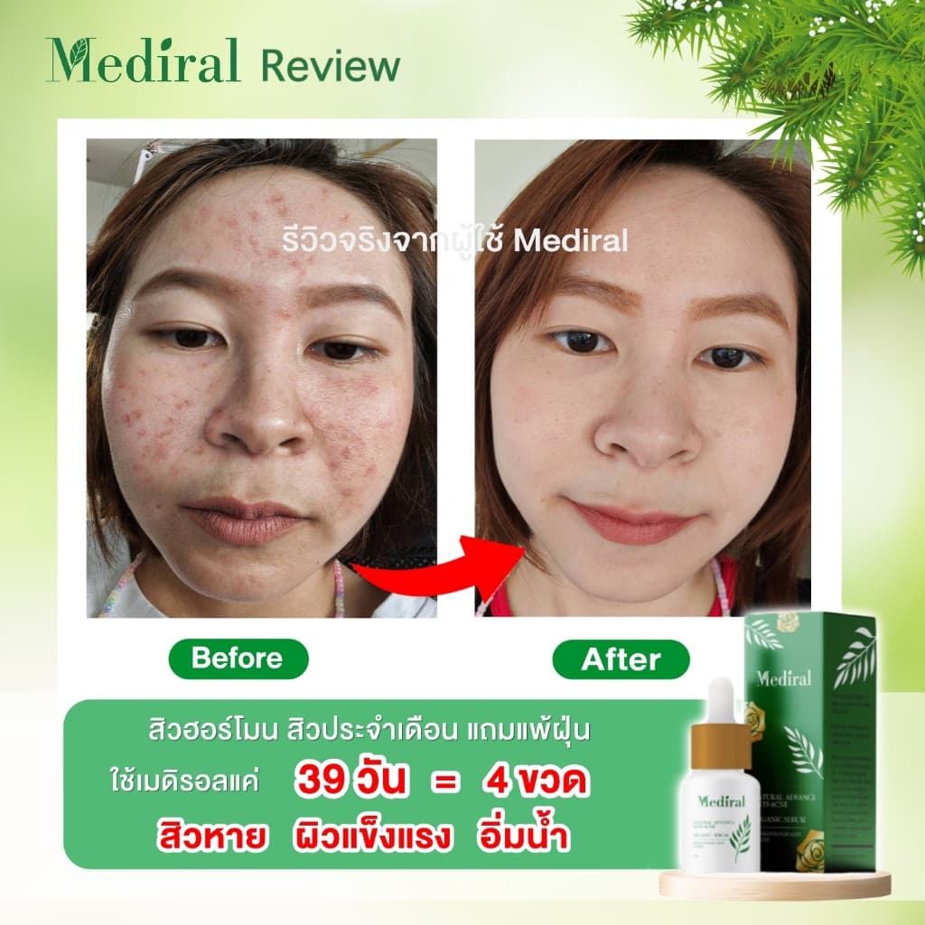 เมดิรอล เซรั่มลดสิวMediral ตัดวงจรสิวซ้ำซาก ฆ่าเชื้อสิวใน7วันดีขึ้น ผิวแข็งแรง ออร์แกนิก รูปที่ 7