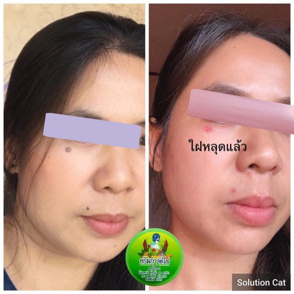 ครีมไฝจีจี้ ขี้แมลงวัน ติ่งเนื้อ หูด ตาปลา แก้ปัญหา กระ สิวหิน ครีมแต้มไฝจีจี้ไฝ หูด จี้ไฝ แต้มไฝ หูดติ่งเนื้อ รูปที่ 6