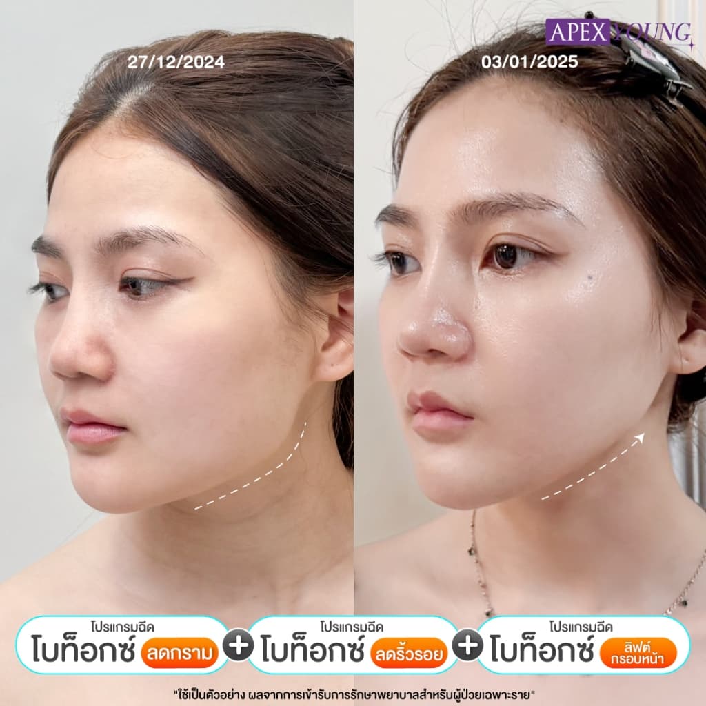 APEX โปรแกรมBo โบท็อกซ์ ลดกราม ลดริ้วรอย ลิฟต์กรอบหน้า 50U + ultraformer หน้าเรียว X2 รูปที่ 3