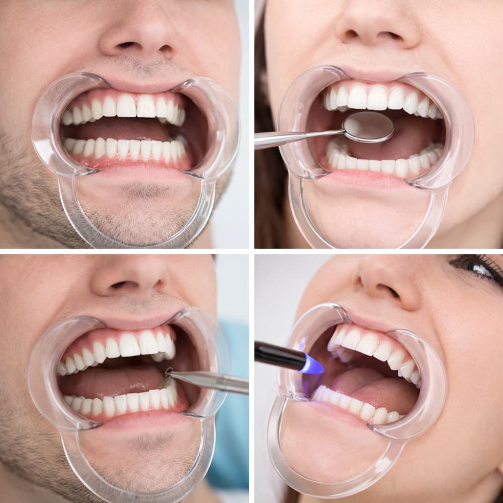 ที่ถ่างปาก ที่อ้าปาก ช่วยอ้าปาก ที่เปิดปาก retractor C type รูปที่ 2