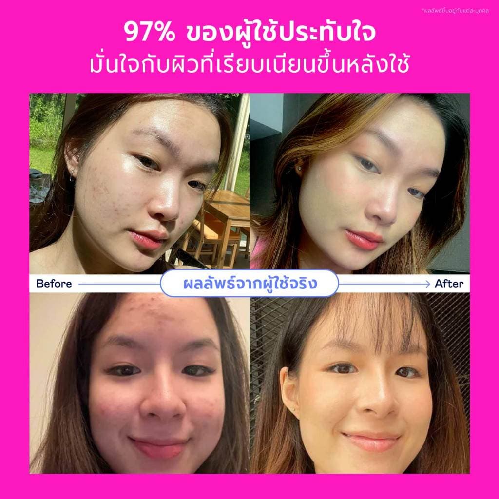 DIVYNE Skincare Promotion Set | เซตผิว Limited Edition มาส์ก สำหรับสิว รูขุมขน รูปที่ 4