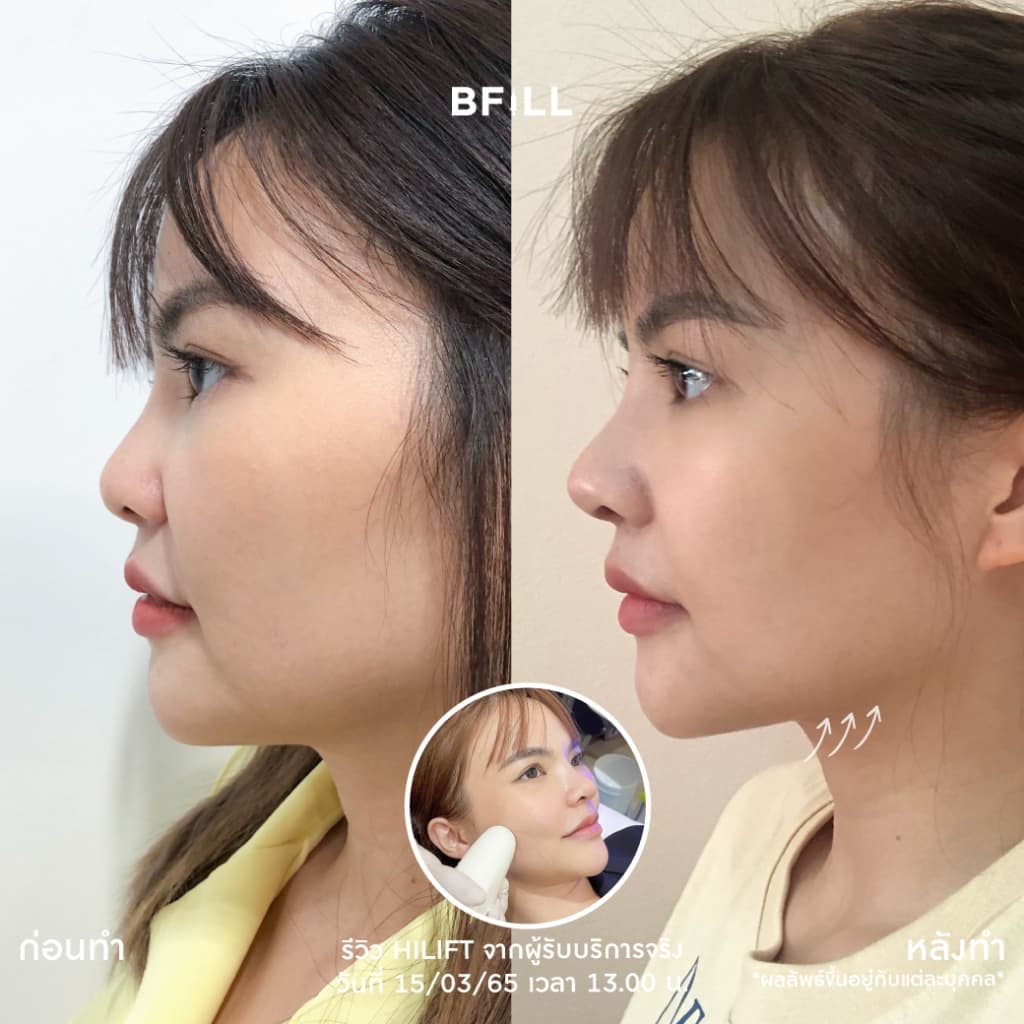 โปรแกรม Hi Lift ไฮลิฟท์ by Specialist ลดแก้มป่อง, กรอบหน้าชัด | BFiLL Clinic บีฟิล คลินิก รูปที่ 6