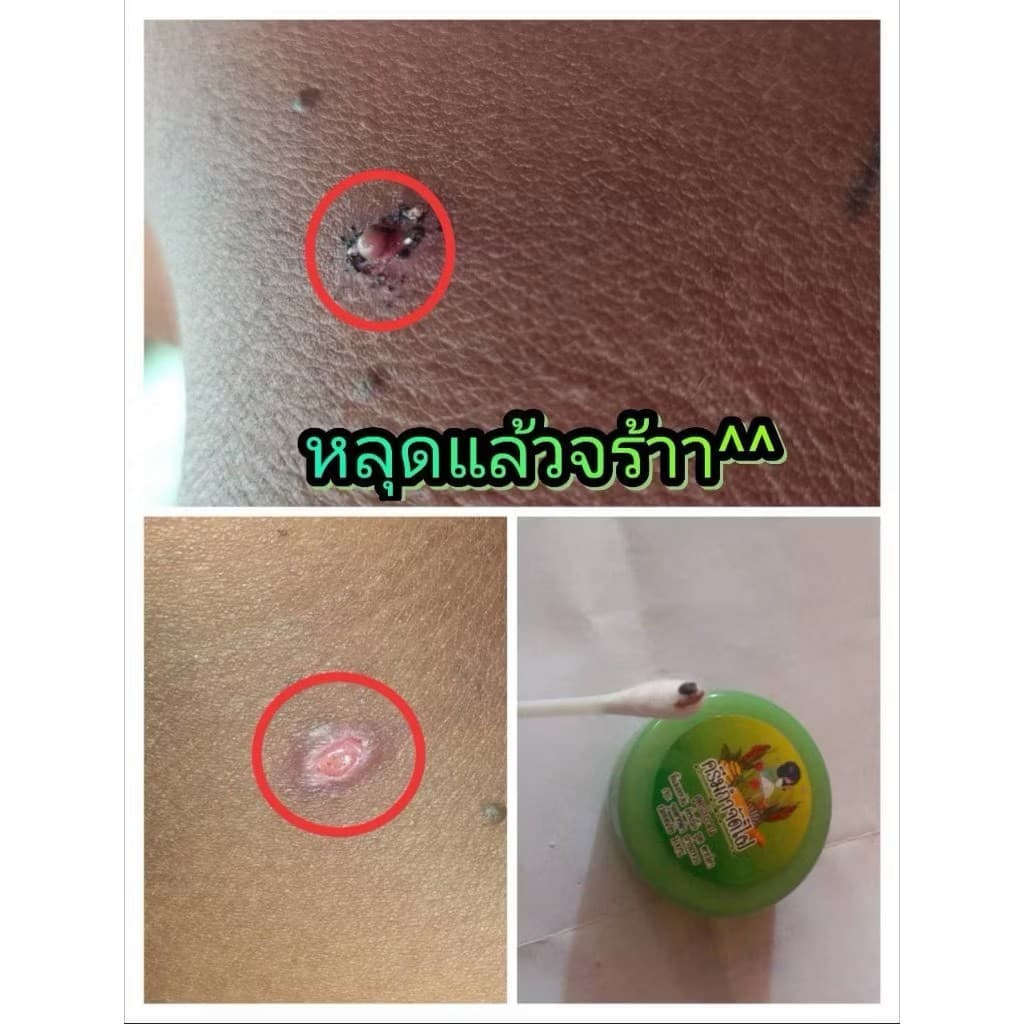 ครีมกำจัดไฝ จีจี้ รูปที่ 3