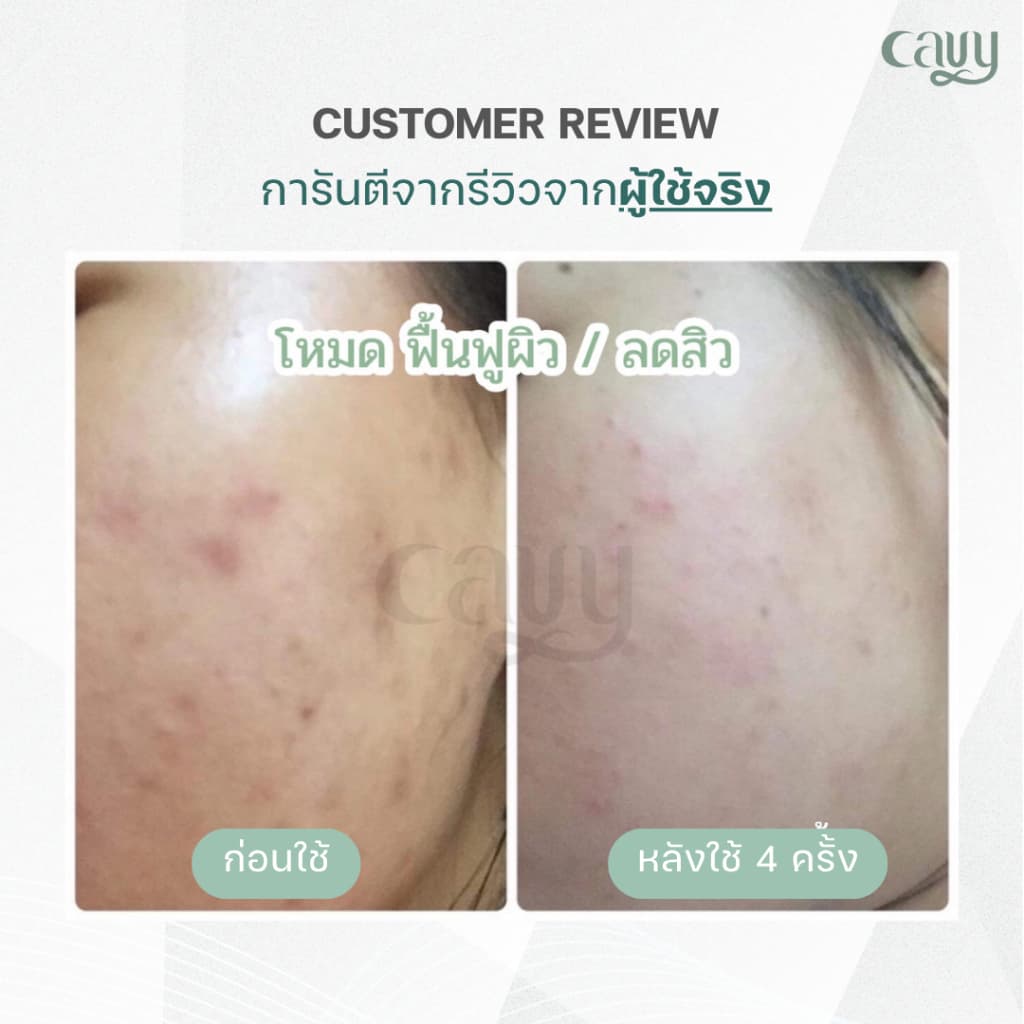 CAVY PLUS IPL 3in1 เครื่องเลเซอร์กำจัดขน หน้าใส ลดสิว 3 ฟังก์ชัน พร้อมโหมดเย็น - ประกัน1ปี รูปที่ 8