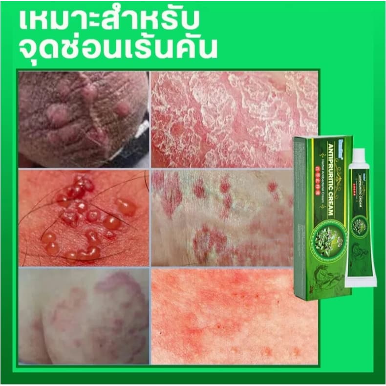 ครีมแก้คันผิว ลดผื่นคัน บรรเทาอาการคัน ฆ่าเชื้อรา ฟื้นฟูผิว เห็นผลไว 20G รูปที่ 5