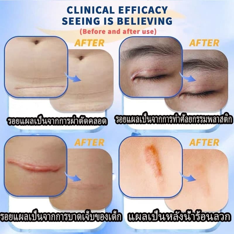 เดอร์มาติกซ์ อัลตร้า เจลลดรอยแผลเป็น ขนาด 15 กรัม เจลลดรอยแผลเป็น รอยผ่าตัด แผลนูน รูปที่ 5